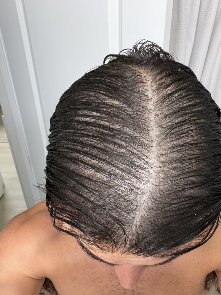 Sam M. (Founder) scalp, month 0