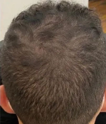 Michael B. scalp, Month 5