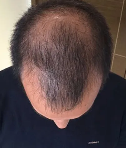 Robert T. scalp, month 0