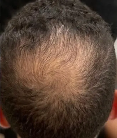 Michael B. scalp, month 0