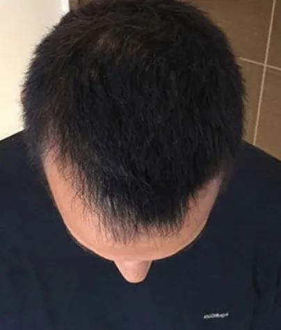Robert T. scalp, Month 6
